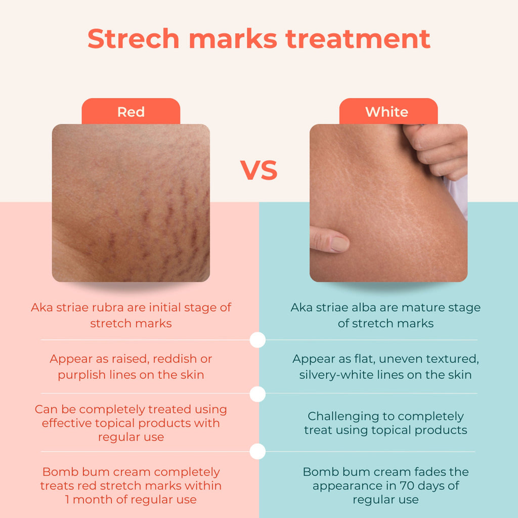Skinvest Bomb bum cream for Stretch Marks + Cellulite