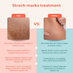 Skinvest Bomb bum cream for Stretch Marks + Cellulite