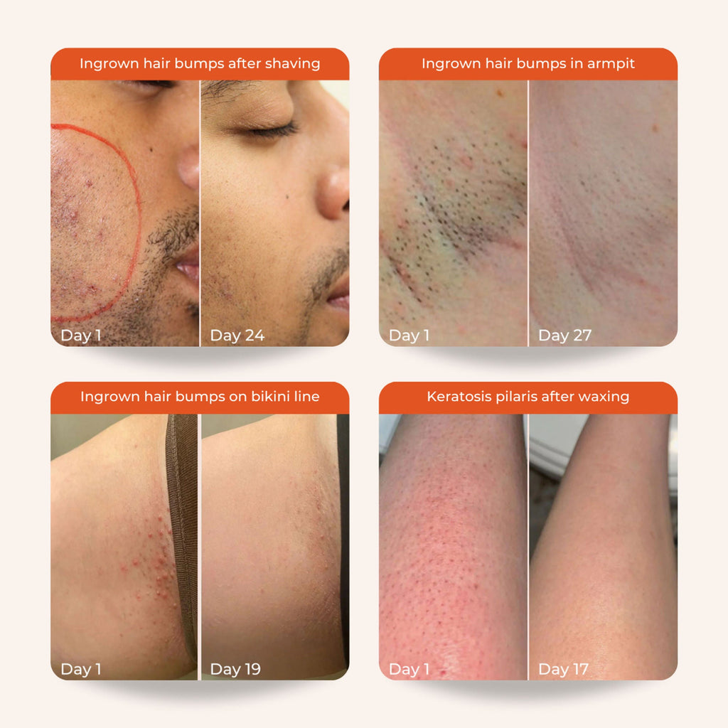 Skinvest Bye Bye Bumps - Exfoliating Body Mist
