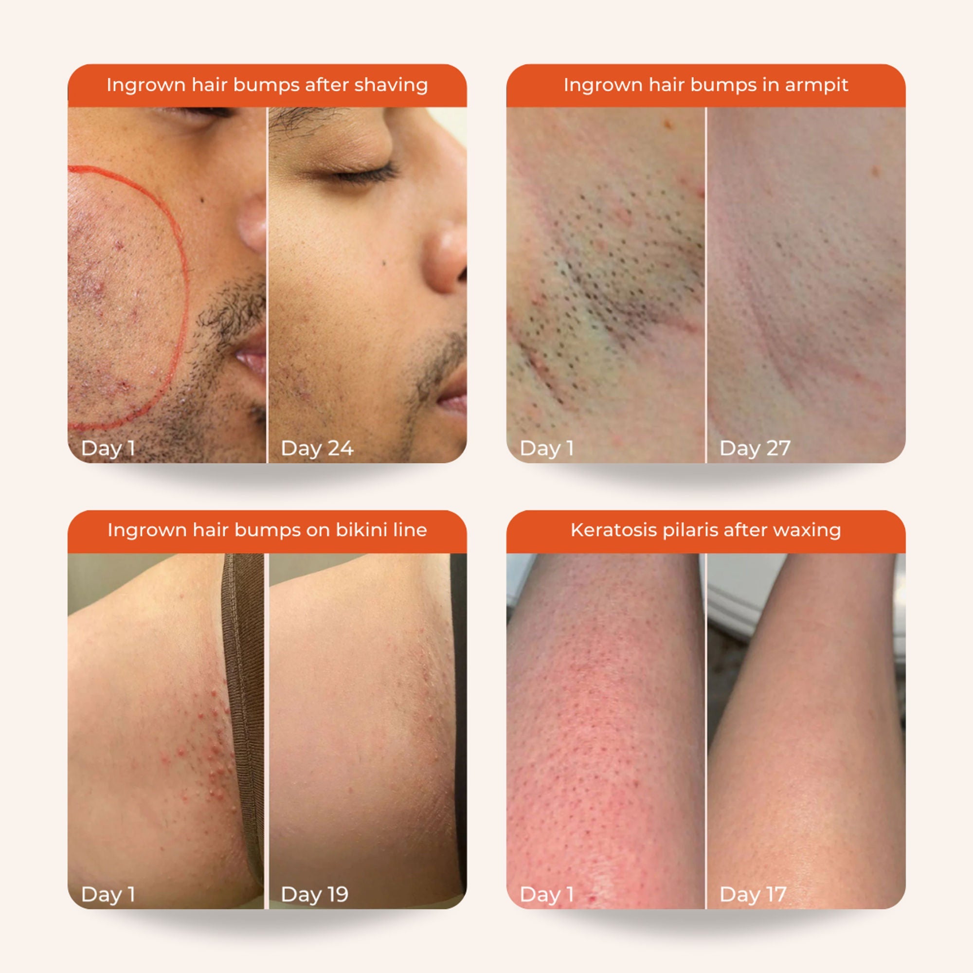 Skinvest Bye Bye Bumps - Exfoliating Body Mist