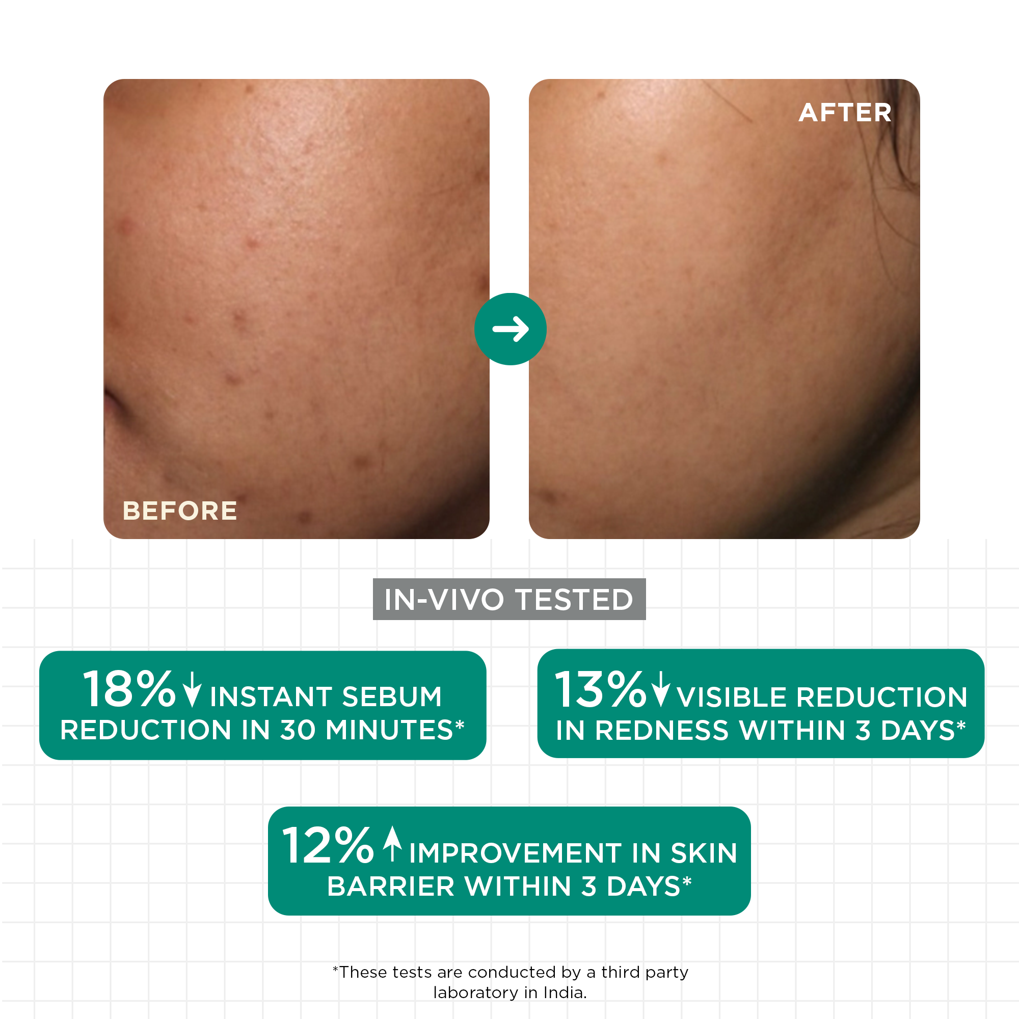 SkinQ Acne & Oil Control Serum