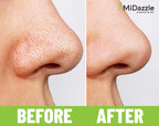 MiDazzle Black Head Remover MIBR3301 - Distacart
