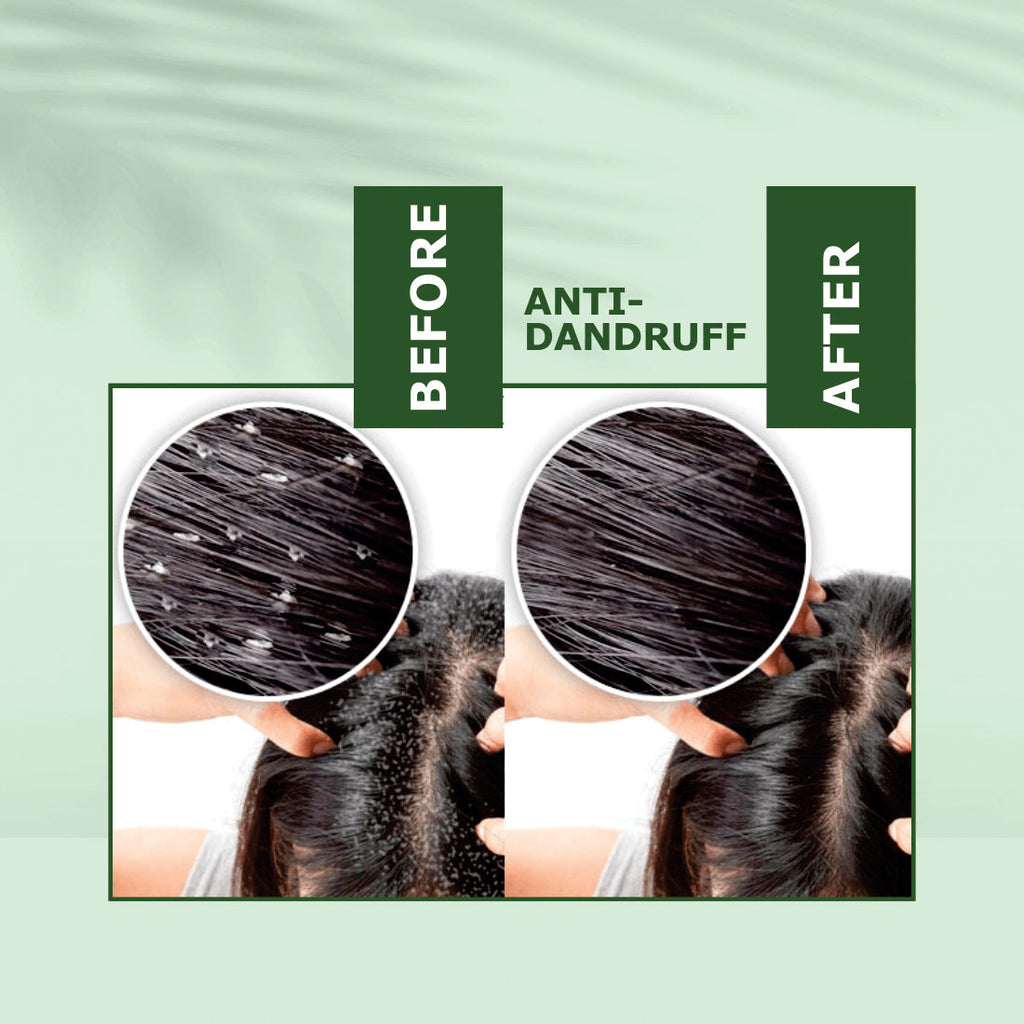 Nuerma Science Anti-Dandruff Oil | Rejuvenate Your Scalp, Rediscover Confidence