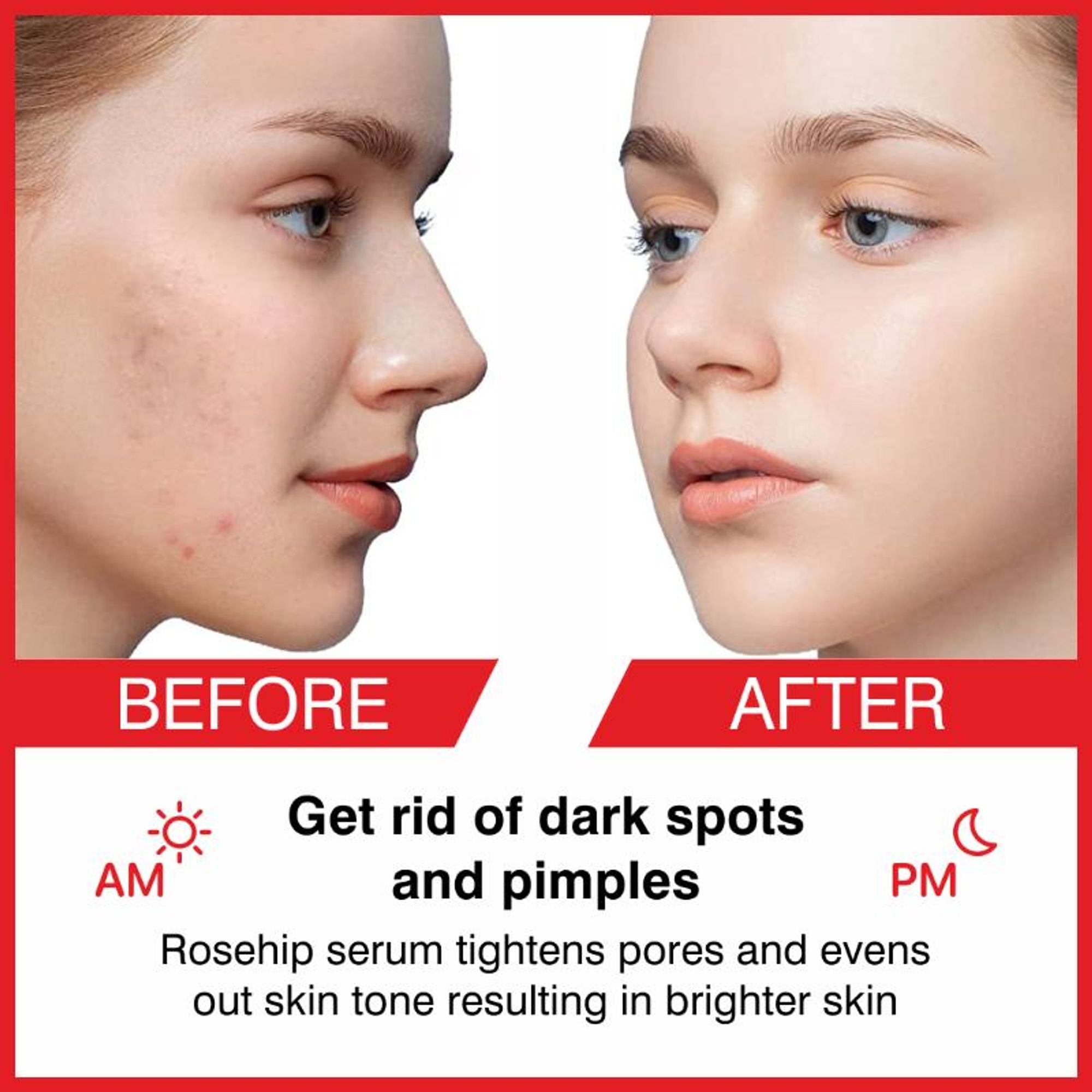 She Essentials Rosehip Face Serum For Tan Pigmentation & Blemish Control