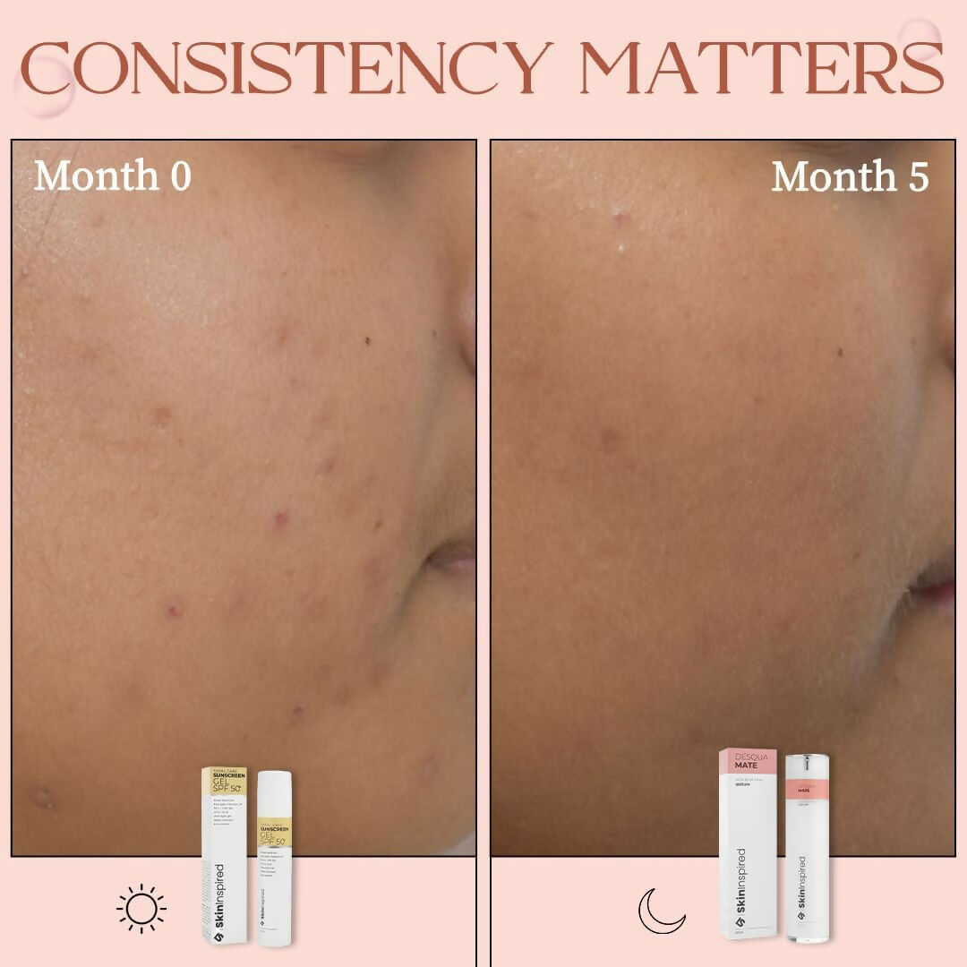SkinInspired AHA+BHA+PHA Lactic Acid + 2% Salicylic Acid Face Serum