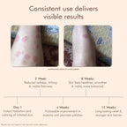 VedicDerm Oleander's Oil for Psoriasis, Eczema, and Atopic Dermatitis - Distacart