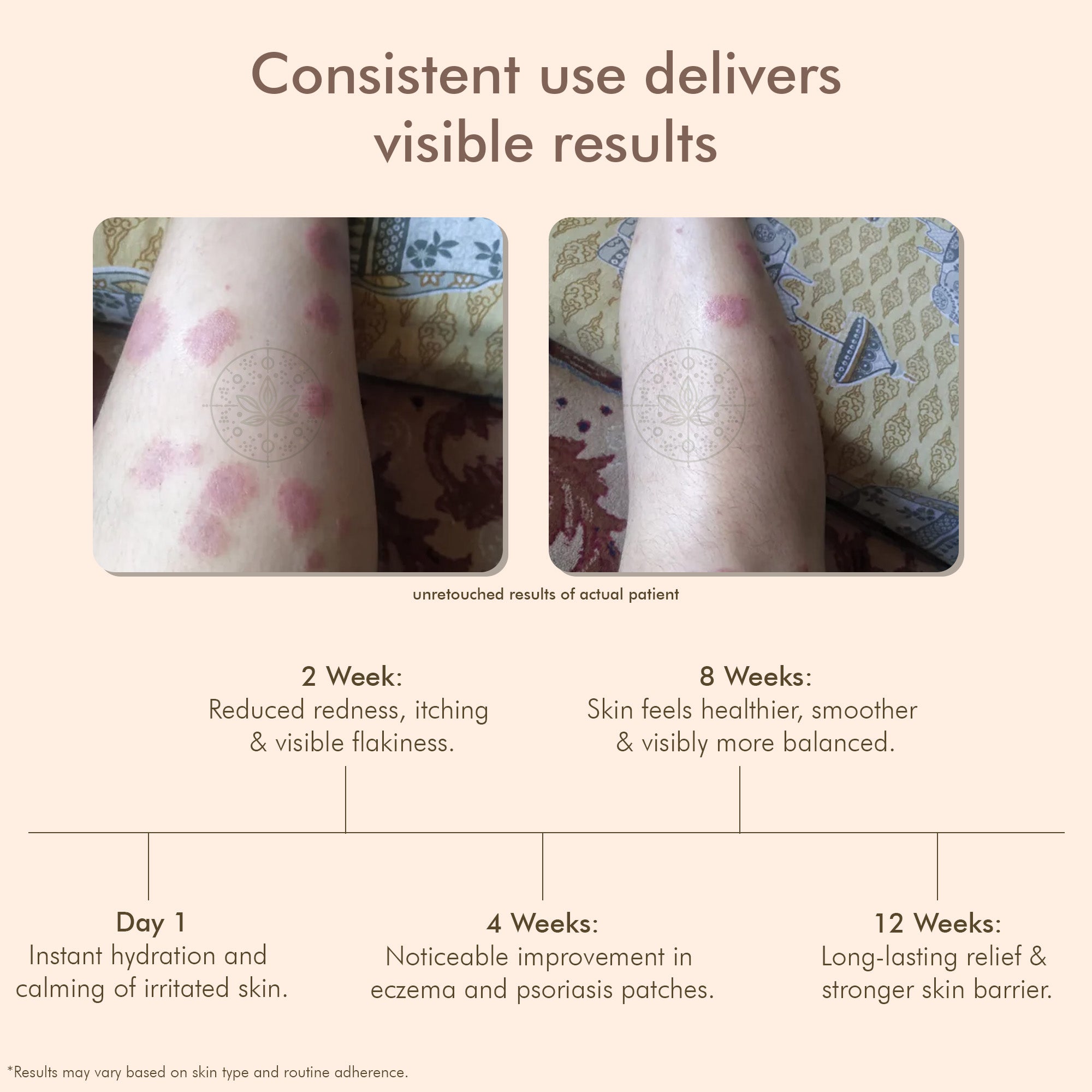 VedicDerm Oleander's Oil for Psoriasis, Eczema, and Atopic Dermatitis - Distacart
