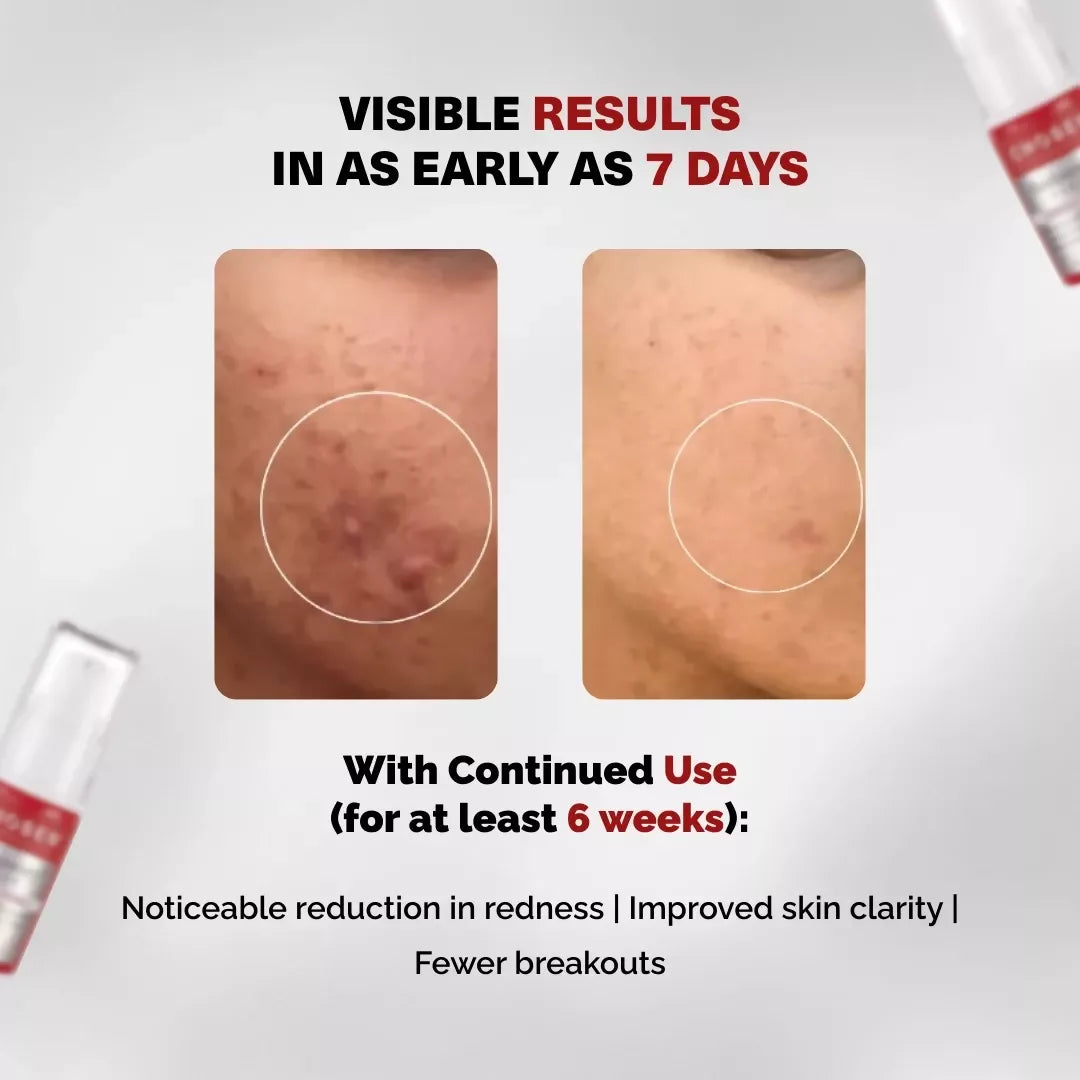 Chosen Re(D)Covery Serum Best Brightening Tranexamic Acid Serum - Distacart