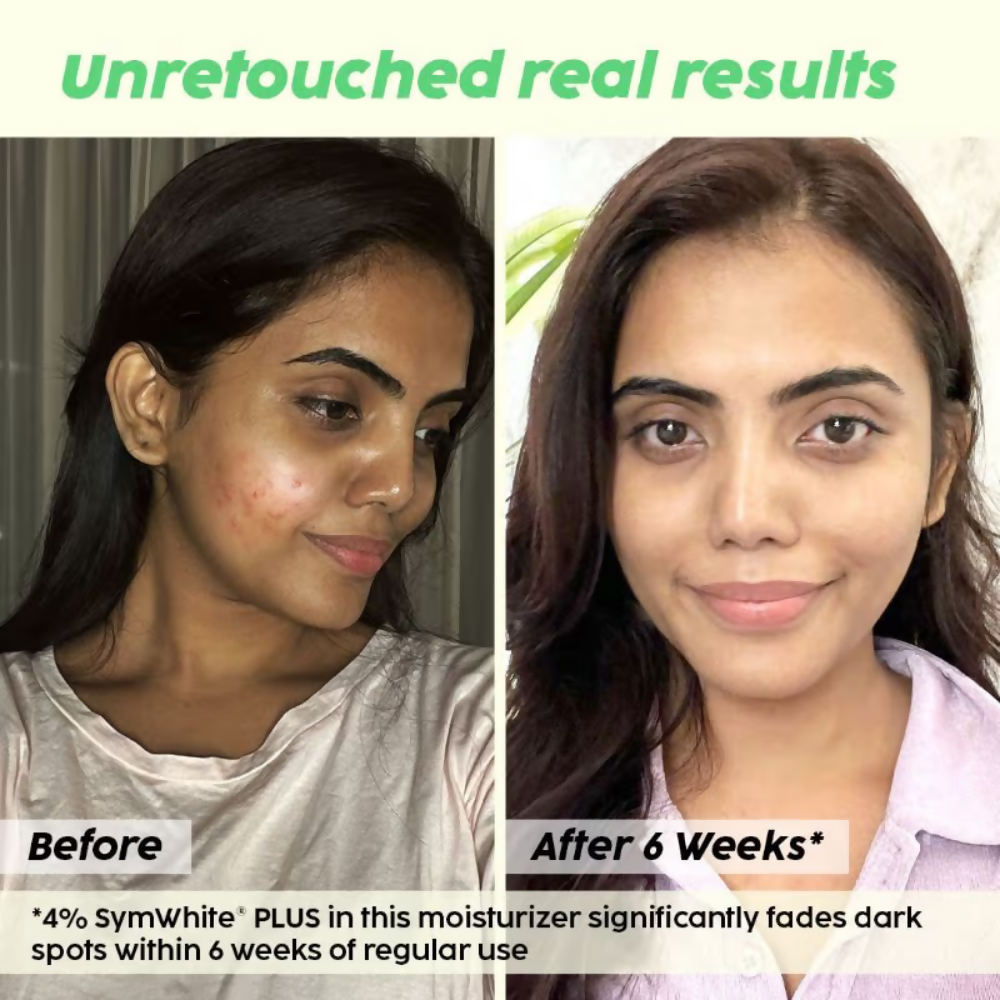 PLIX The Plant Fix 2% Alpha Arbutin Pineapple Moisturizer With SymWhite PLUS For Hyperpigmentation & Dark Spots - Distacart