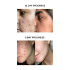 Skog Acne Clarifying Gel