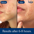Bake Acne Erase XL Pimple Patches & Nose Patches