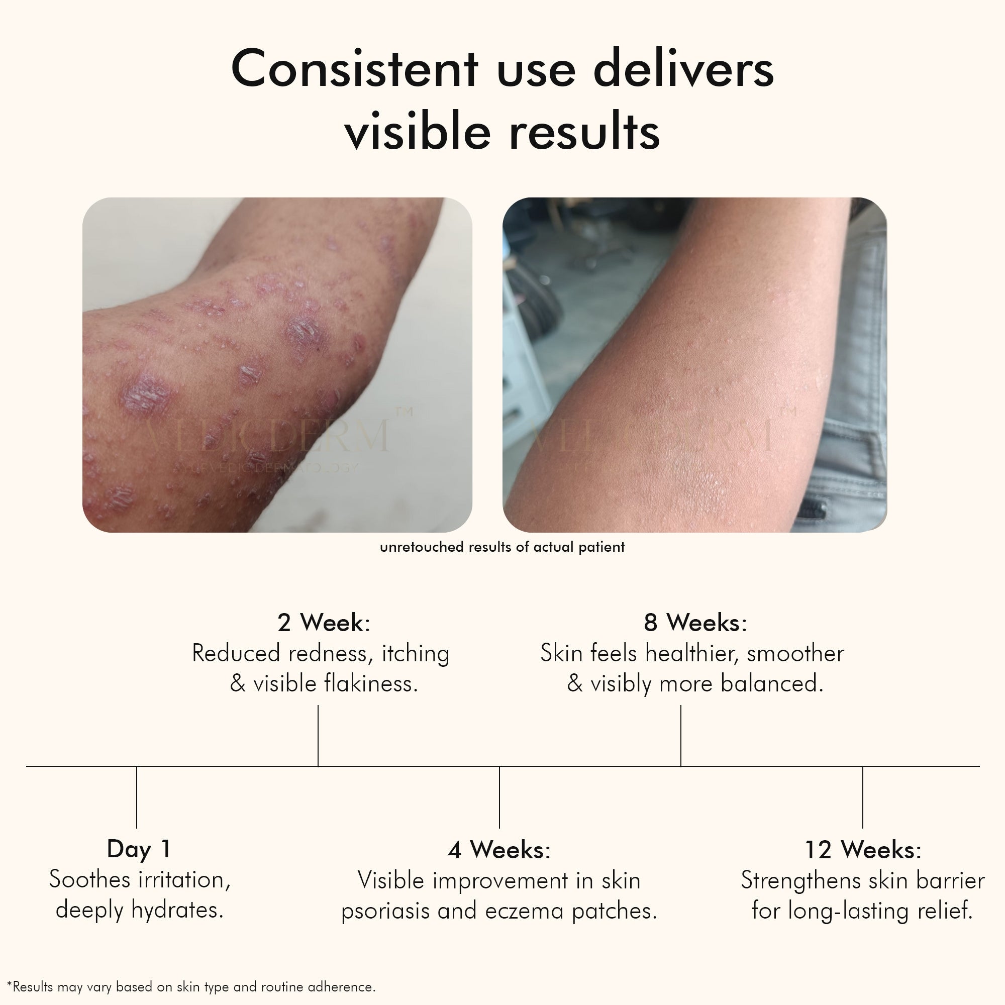 Vedicderm Psoriasis Cream with 2% Bakuchi Extract - Distacart