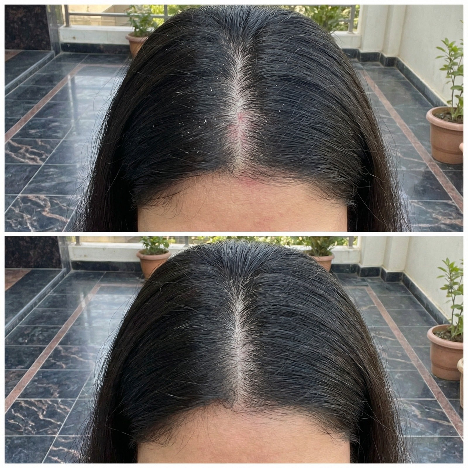 Vedicderm Psoriasis Oil 2-in-1 Skin + Scalp Relief Oil - Distacart