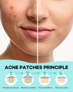 TKTK Acne Patch Pimple Patch - Acne Absorbing Cover Patch, Hydrocolloid Invisible Acne Patches For Face Zit Patch Acne Dots Tea Tree, Calendula Oil