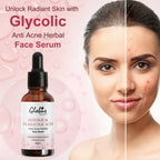 Globus Remedies Glycolic & 1% Salicylic Acid Anti Acne Face Serum