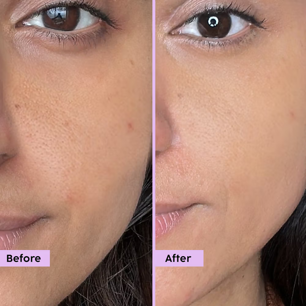 PLIX The Plant Fix - Jamun Active Acne Regime With Cleanser & Toner To Unclog Pores & Reduce Acne