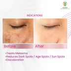 Adonis Ad Mela Tx Cream - Distacart