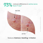 SkinInspired AcNil3 Rapid Spot Corrector