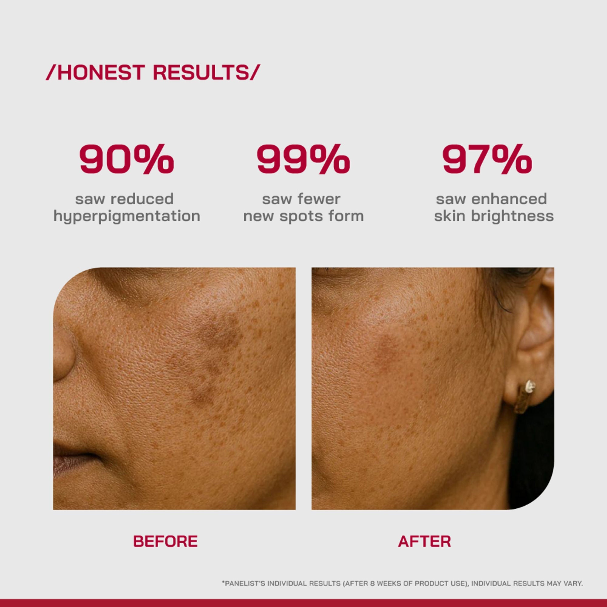 Proven Honest Derma (PHD) 2% Alpha Arbutin Serum - Distacart