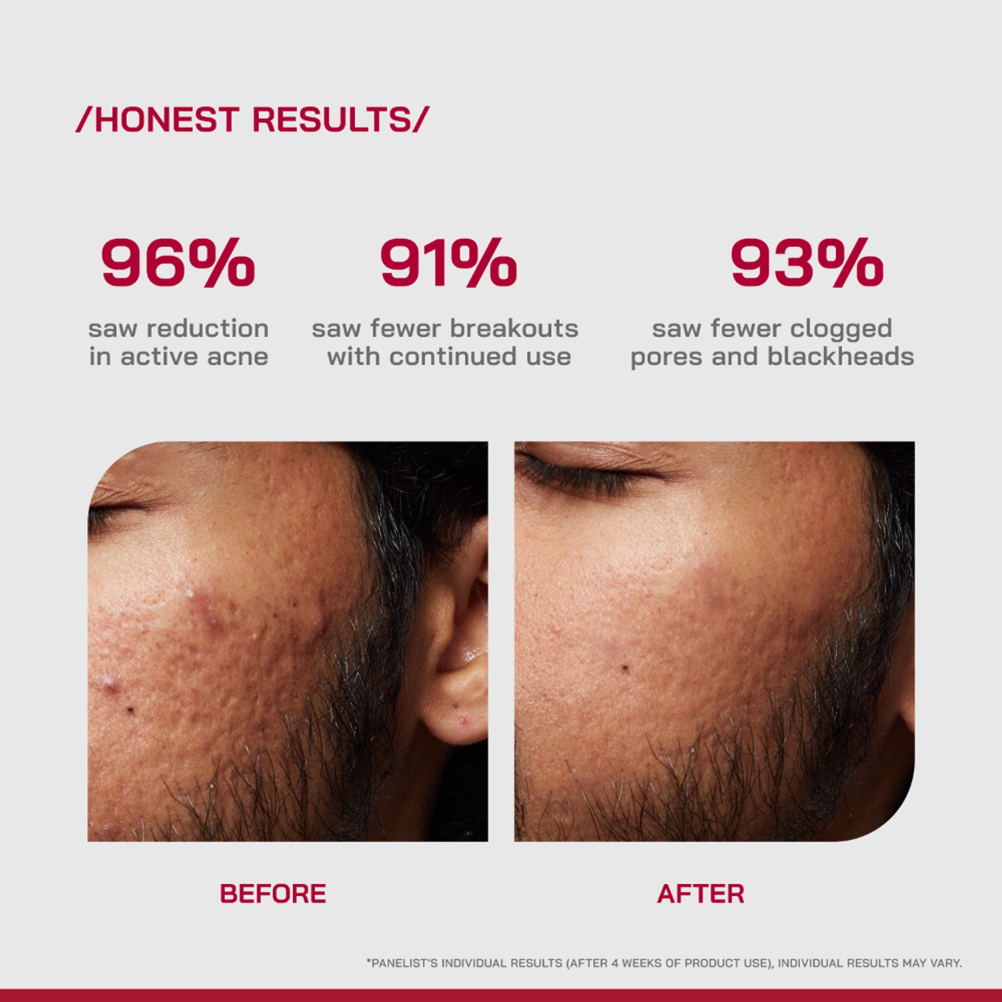 Proven Honest Derma (PHD) 2% Salicylic Acid Anti-Acne Serum - Distacart
