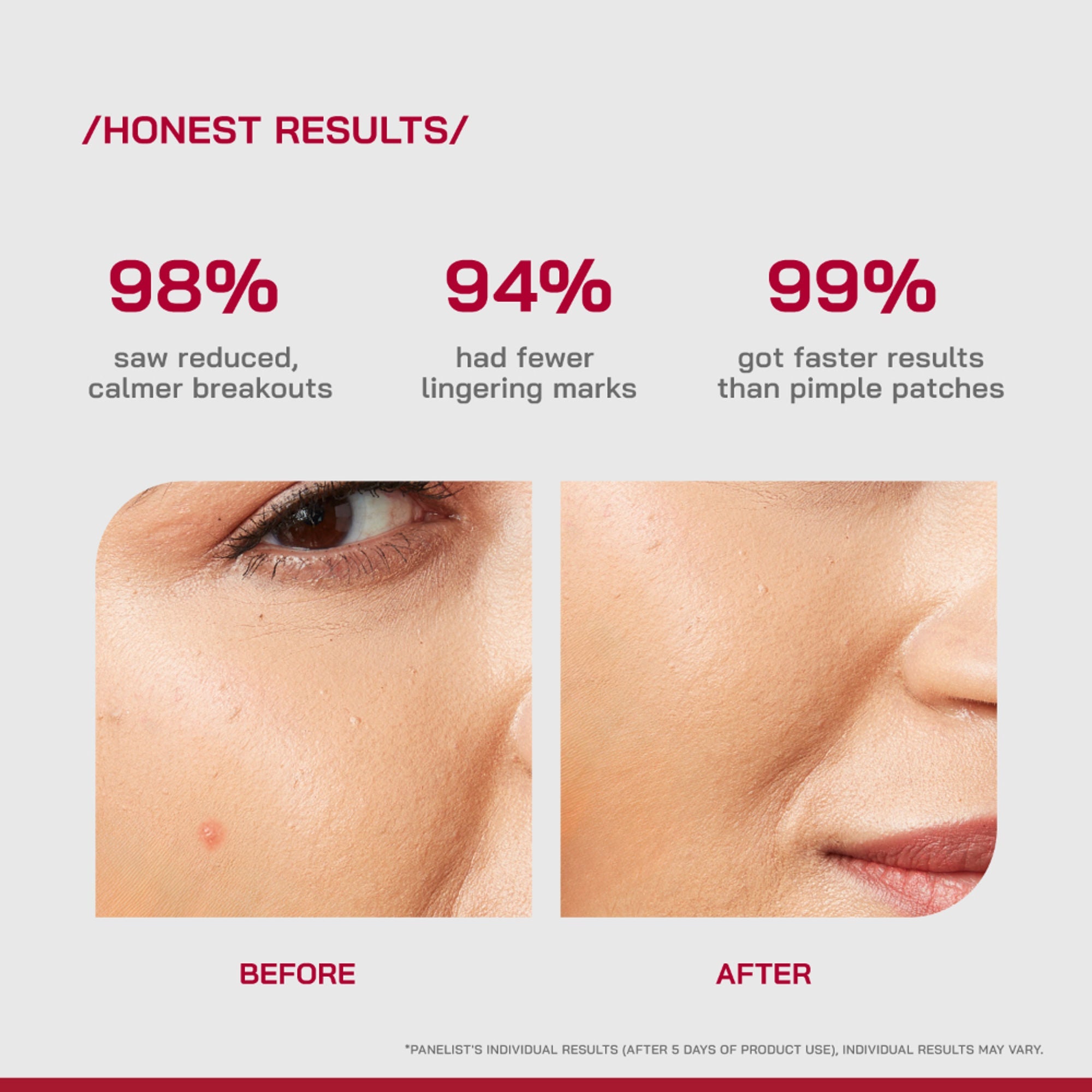 Proven Honest Derma (PHD) Salicylic Acid Acne Spot Gel - Distacart