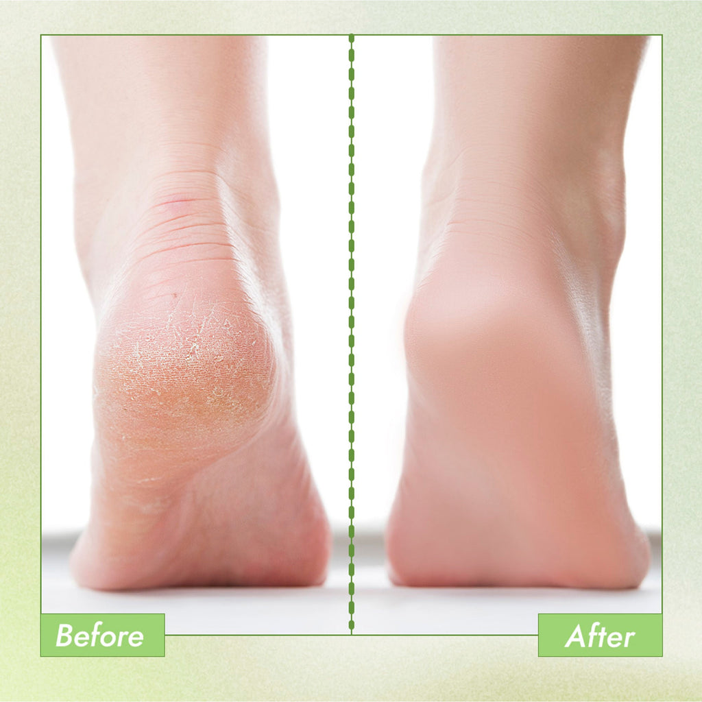 Nykaa Skin Happy Heels 20%Urea, 2%Lactic Acid Foot Cream-Dry & Cracked Feet - Tea Tree & Aloe Vera - Distacart