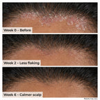 VedicDerm Sensitive Scalp Bundle for Psoriasis, Dandruff, & Itchy Scalp - Distacart