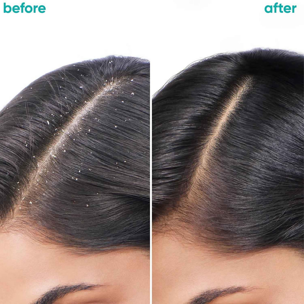 Matrix Biolage Scalppure Anti-Dandruff Shampoo and Conditioner Combo