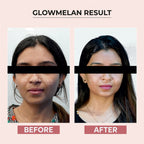 Dr.Sakhiya Glowmelan Brightening & Depigmentation Gel Cream - Distacart