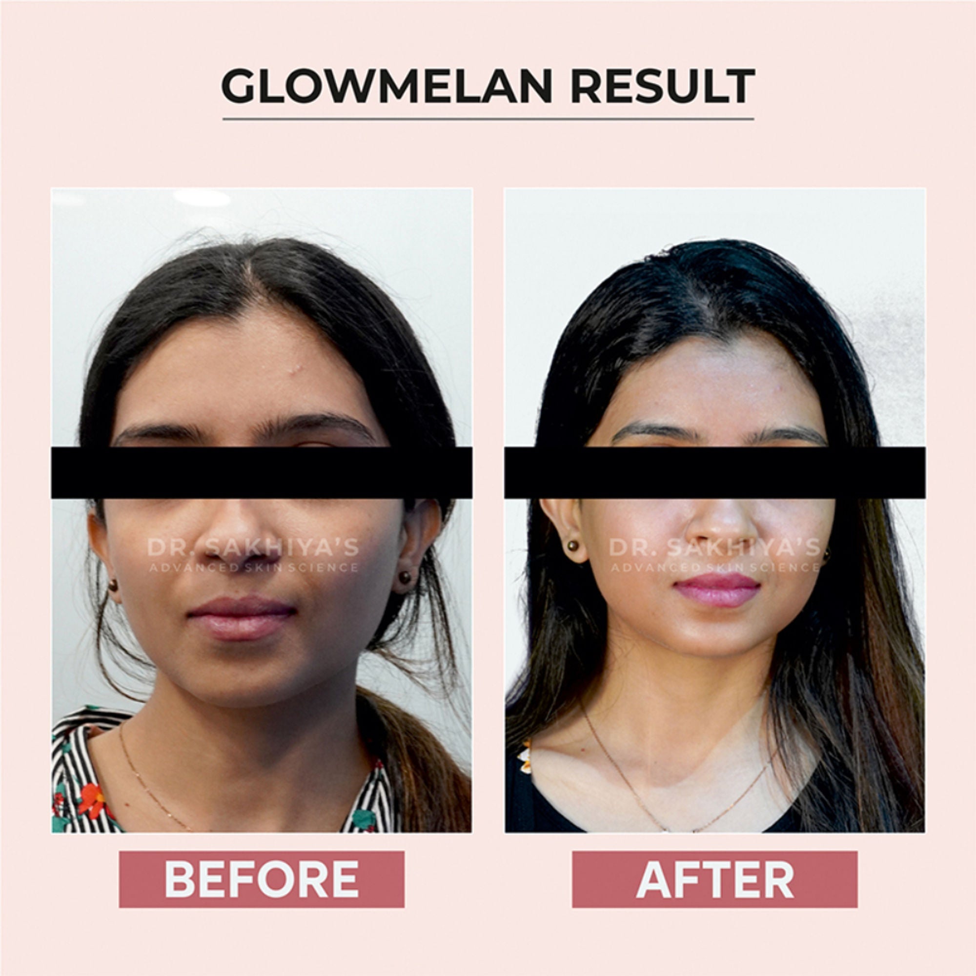 Dr.Sakhiya Glowmelan Brightening & Depigmentation Gel Cream - Distacart