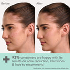 Lotus DermaBotanics Kojic Acid + Multi Berry Blemish-Free Face Wash, pH5.5, For Sensitive Skin