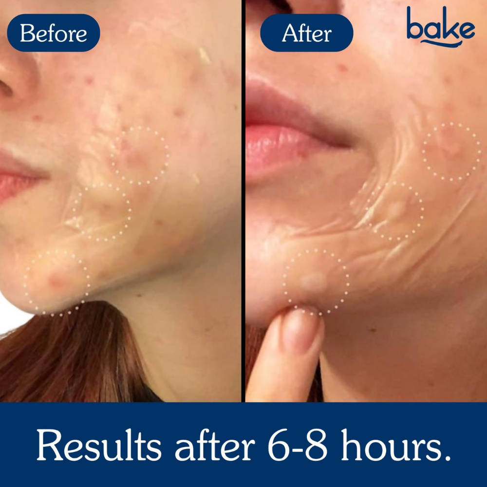 Bake Acne Erase XL Pimple Patches - Distacart
