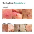 SkinInspired AcNil3 Rapid Spot Corrector