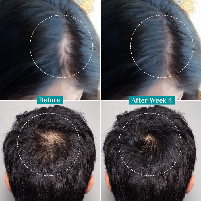 Pilgrim 3% Redensyl, 4% Anagain & 5% Capilia Stem Cell Complex Advanced Hair Growth Serum Roll-On - Distacart
