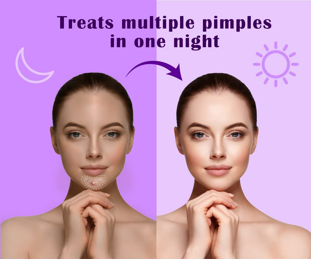 Urban Yog Acne Curvy Pimple Patch - Invisible Facial Stickers cover