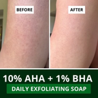 Bake 10% AHA + 1% BHA Scrub Treatment Soap