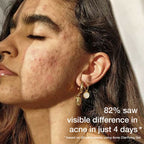 Skog Acne Clarifying Gel