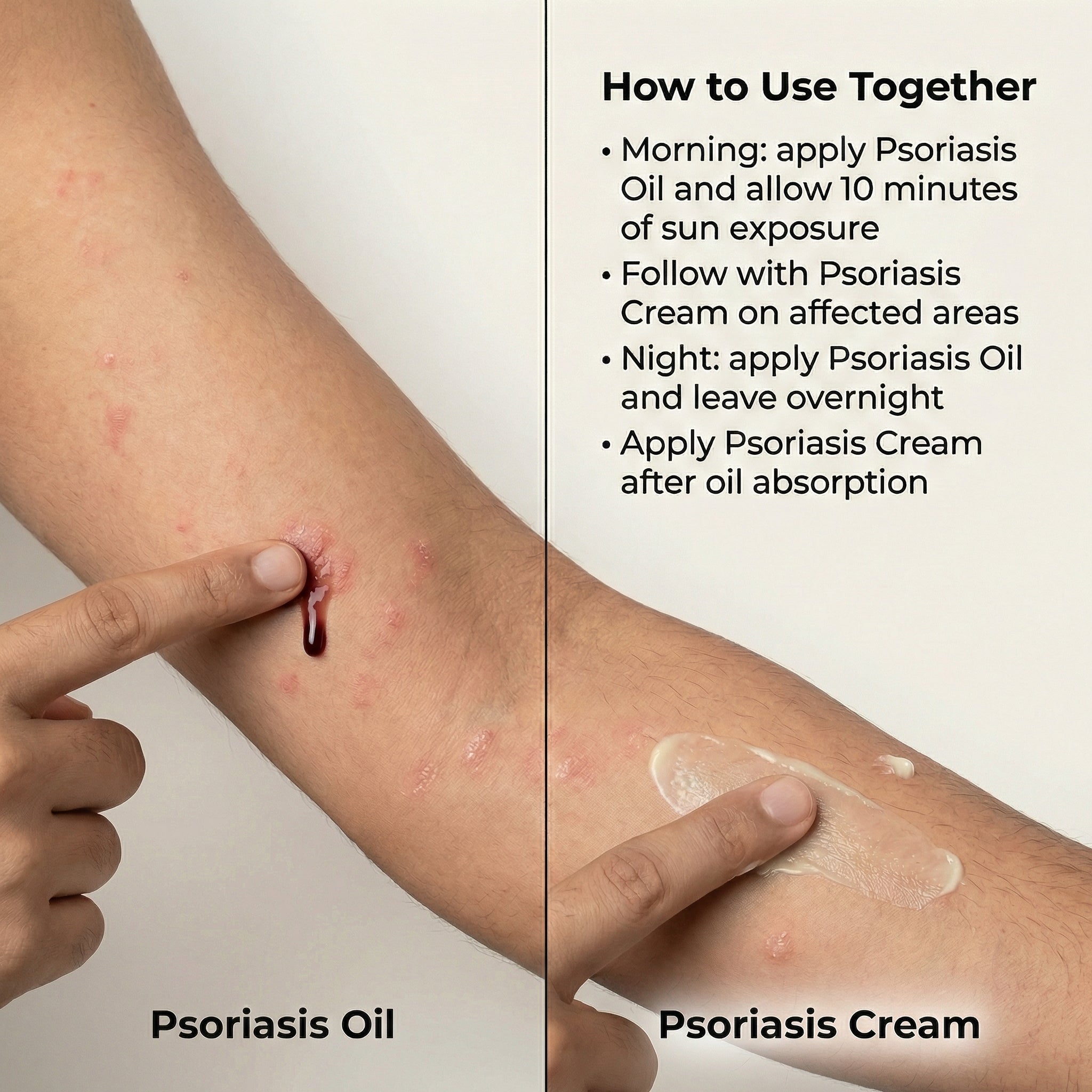 VedicDerm Sensitive Skin Bundle for Psoriasis, Eczema, Atopic Dermatitis - Distacart