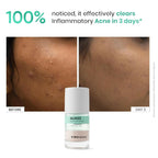 SkinInspired AcNil3 Rapid Spot Corrector