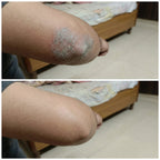 Vedicderm Psoriasis Cream - Distacart