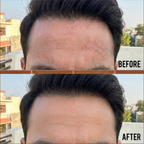 VedicDerm Sensitive Scalp Bundle for Psoriasis, Dandruff, & Itchy Scalp - Distacart