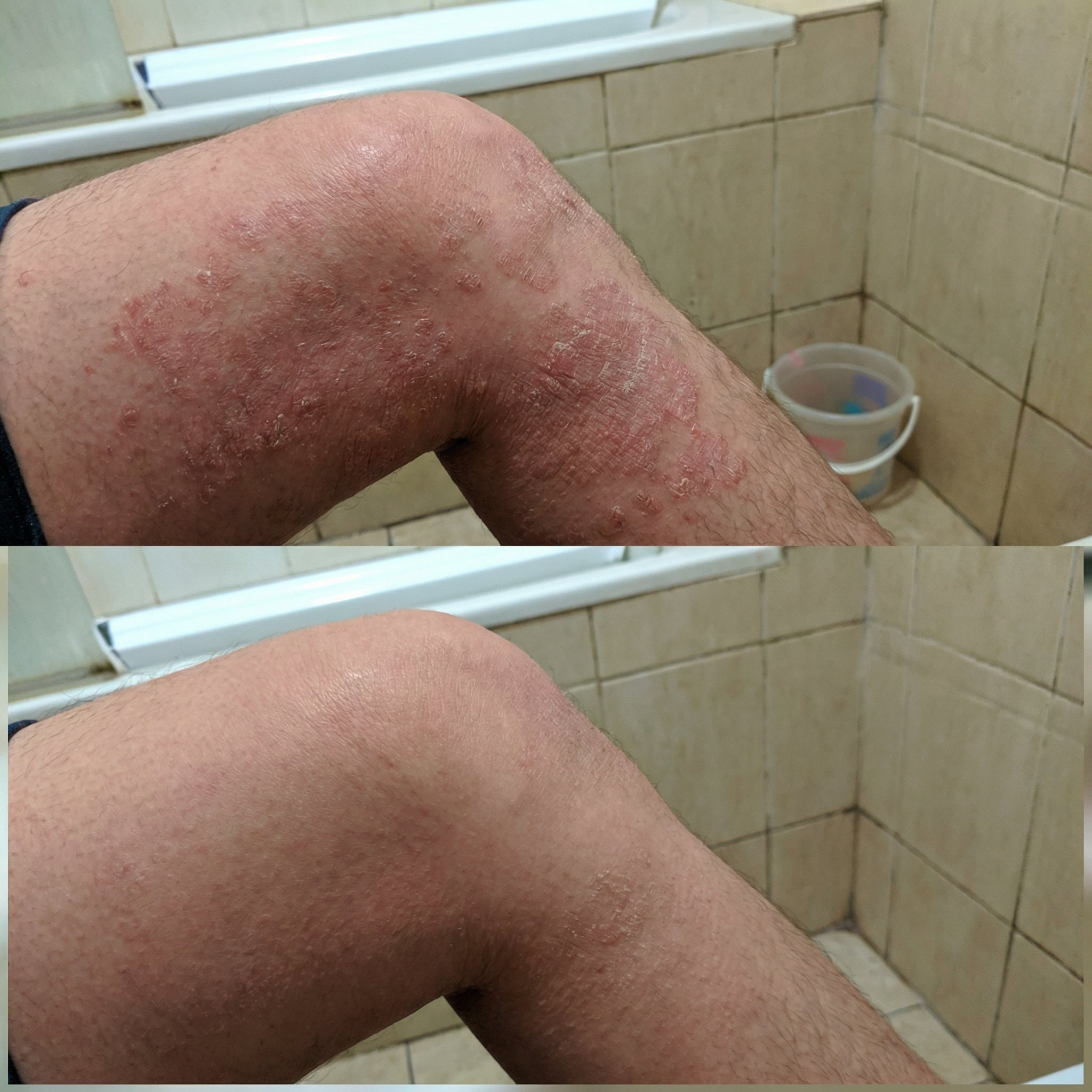 Vedicderm Psoriasis Cream - Distacart