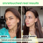 PLIX The Plant Fix Jamun Active Acne Kit With Spf 50+ Sunscreen & Juicy Cleanser