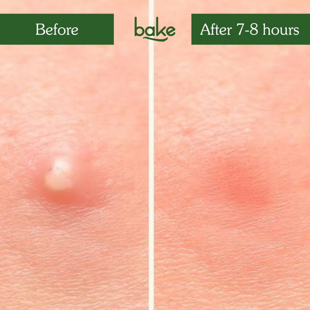 Bake Zit Erase Micro point Patches for Active Acne & Breakouts