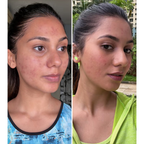PLIX The Plant Fix 2% Acne Buster Moisturizer & 10% Niacinamide Serum
