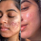House of Beauty Acne Drying Serum