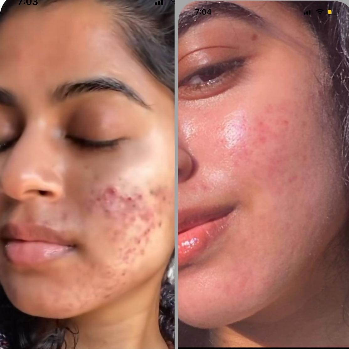 House of Beauty Acne Drying Serum